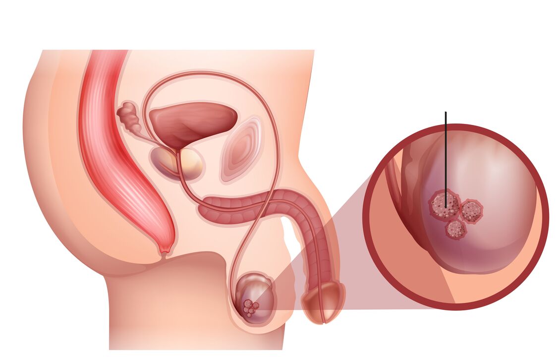 Signs of prostate cancer