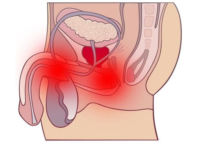Methods for treating prostatitis