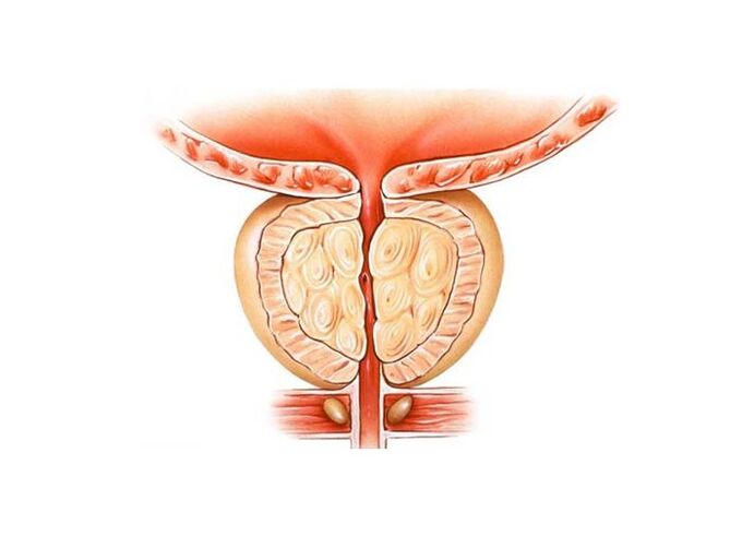 Treatment of prostatitis with folk remedies